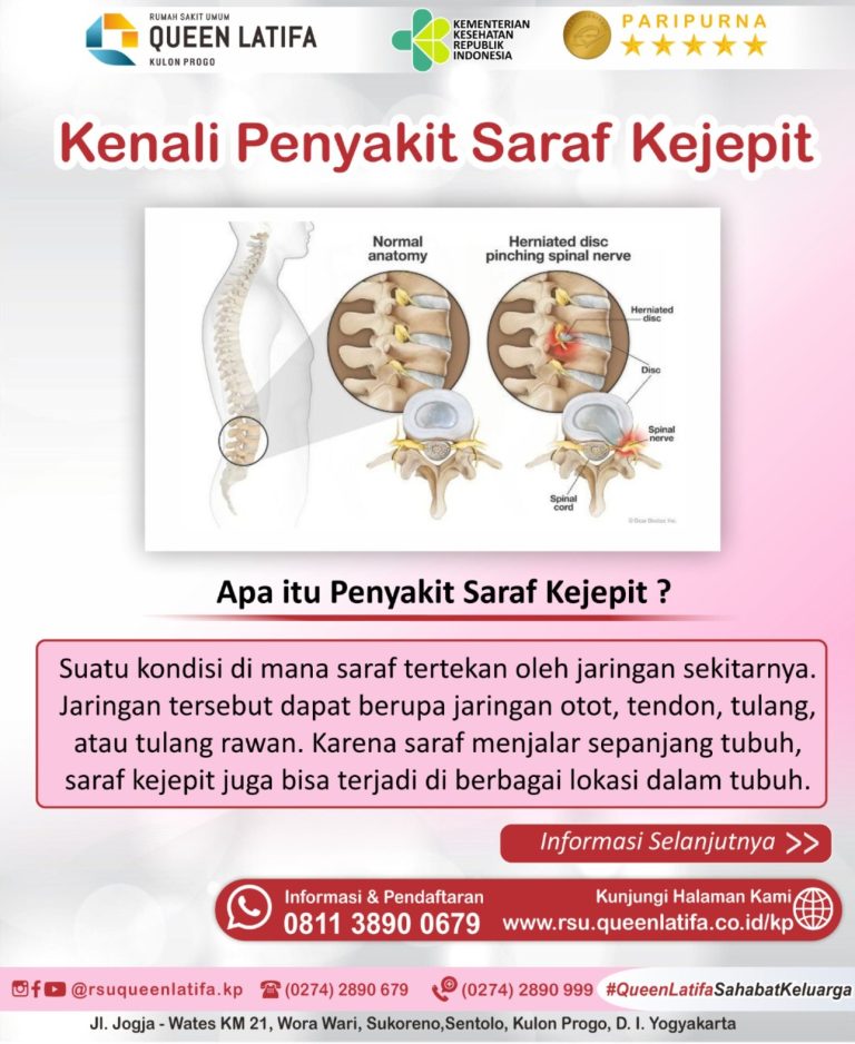 Edukasi Penyakit Saraf Kejepit